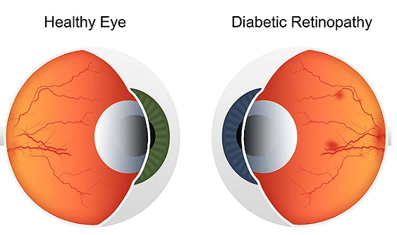 Can Eye Doctor Detect Diabetes